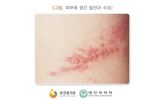 대상포진 원인부터 증상·치료·예방까지