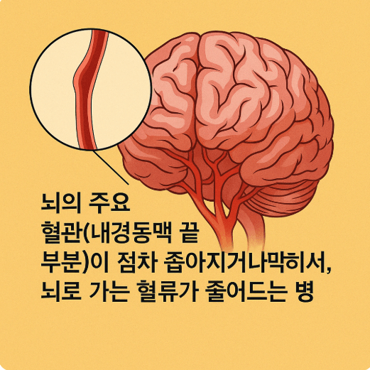 모야모야병 증상 원인 유전 치료법|산정특례 등록