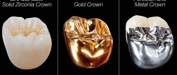 지르코니아가격-크라운비용