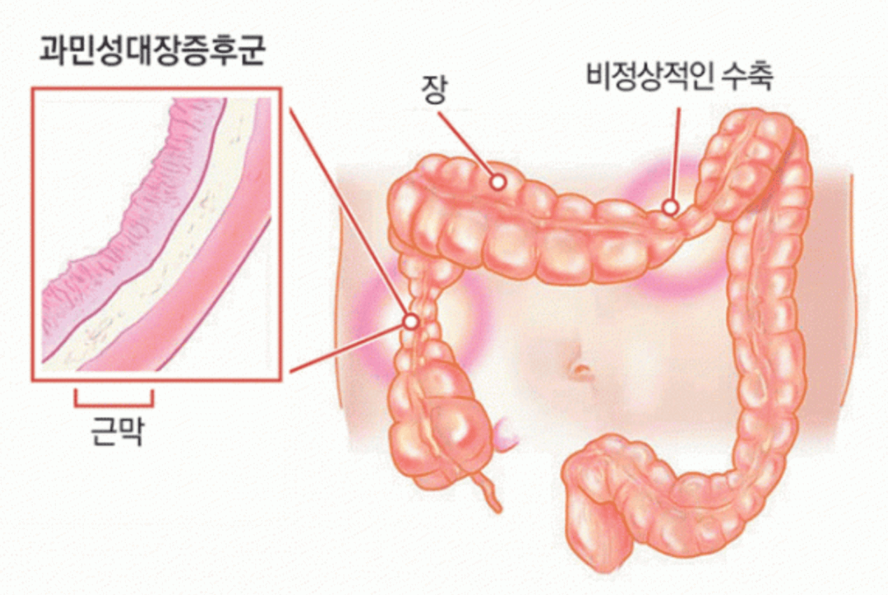 과민성 대장 증후군 간단 치료법