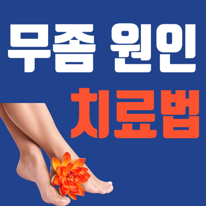 무좀 원인, 치료법