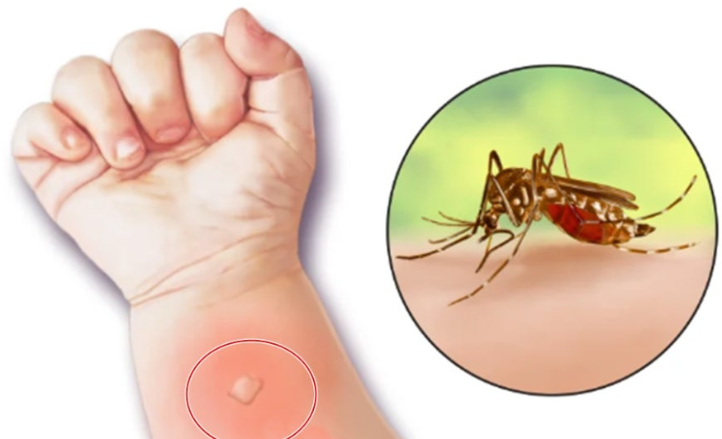 아기 모기 알러지증상(스키터증후군) 및 두드러기 챔프 알러논