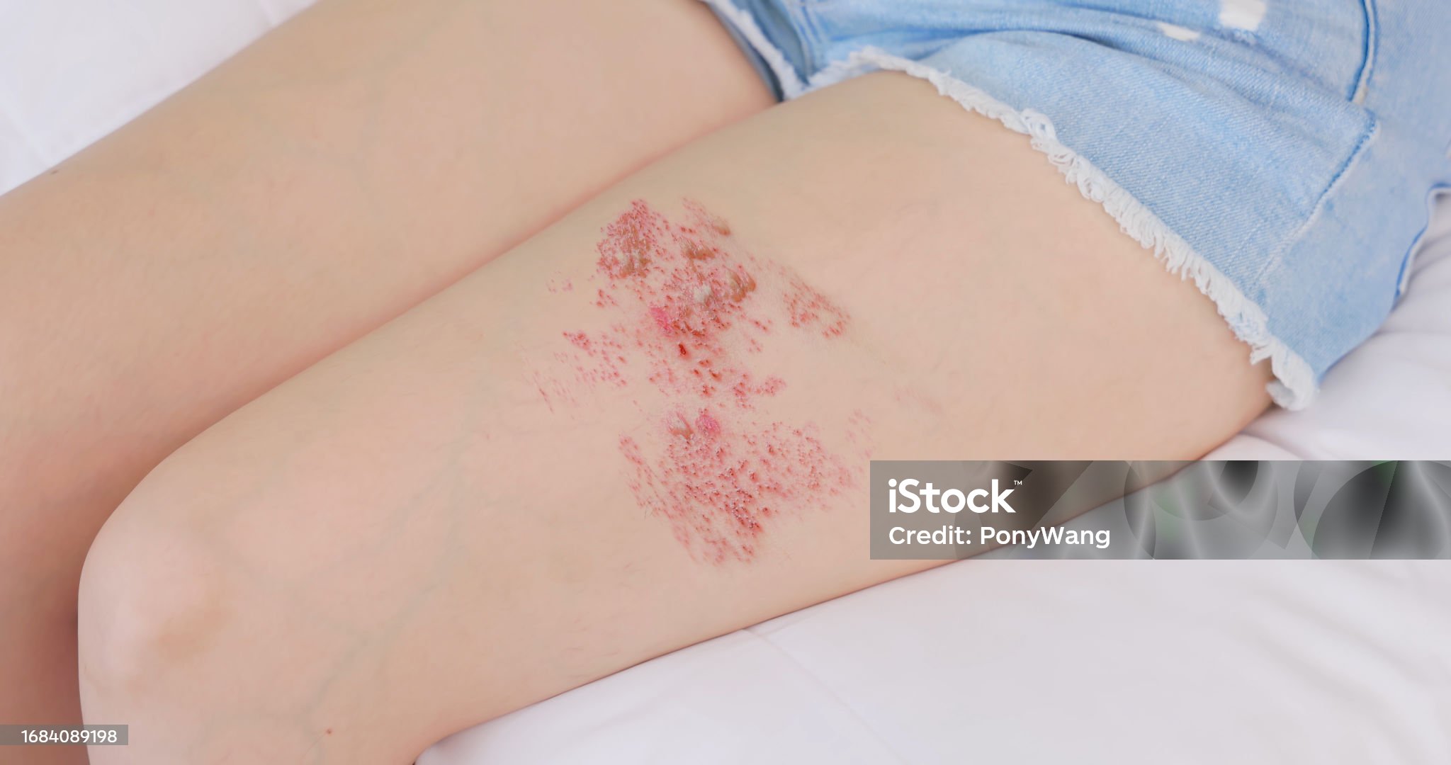 대상포진-관련-사진