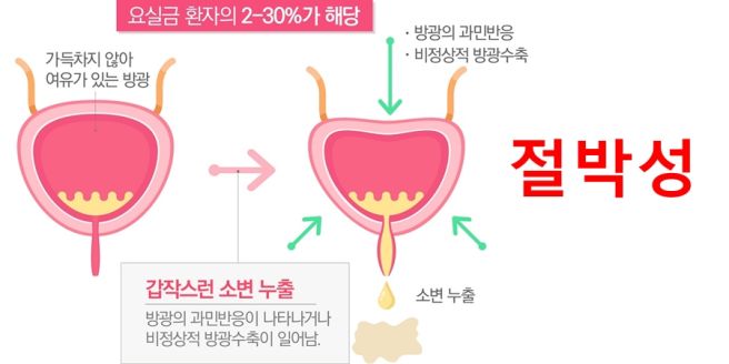 요실금 치료방법