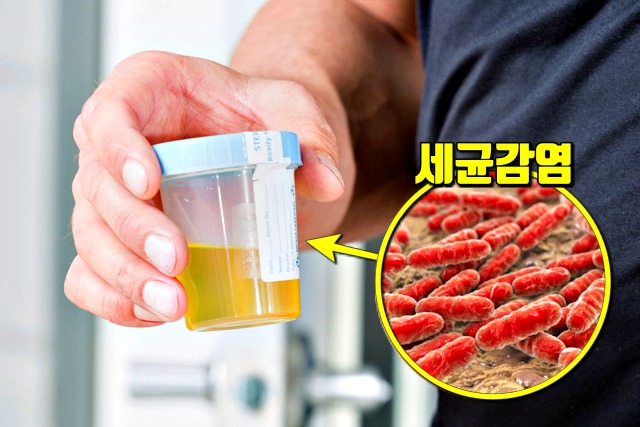 소변에서 냄새가 나는 이유 방광염 요로감염, 건강 팁줌