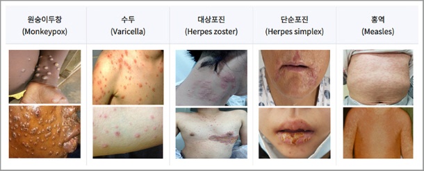 엠폭스-초기증상