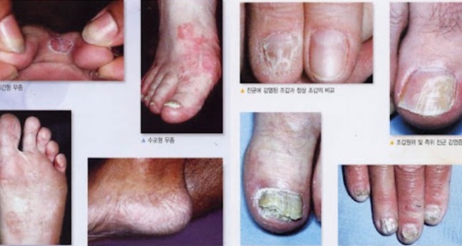 무좀 이미지