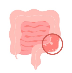 대장내시경 전 음식 초기증상