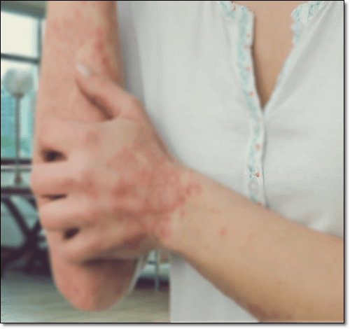 대사장애로 인한 아토피 피부염 환자 