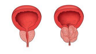 전립선 비대증 사진