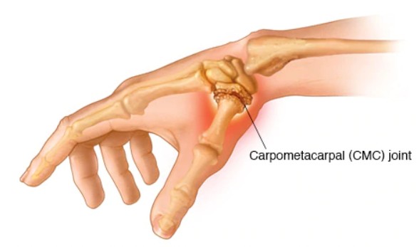 손목손허리관절 관절염으로 인한 손의 통증인가요? 증상, 작업치료