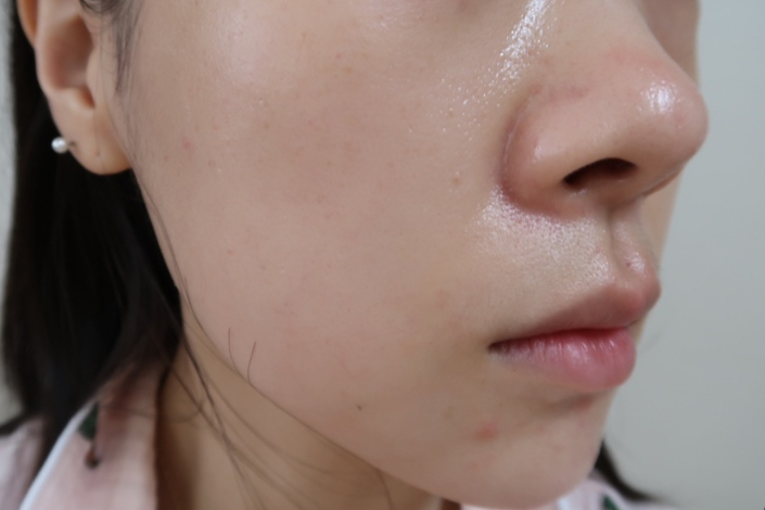 bbl 레이저 후기