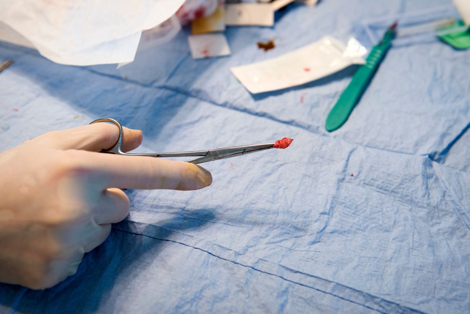 수술적 생검(Surgical Biopsy): 병변의 정확한 진단을 위한 신뢰도 높은 검사