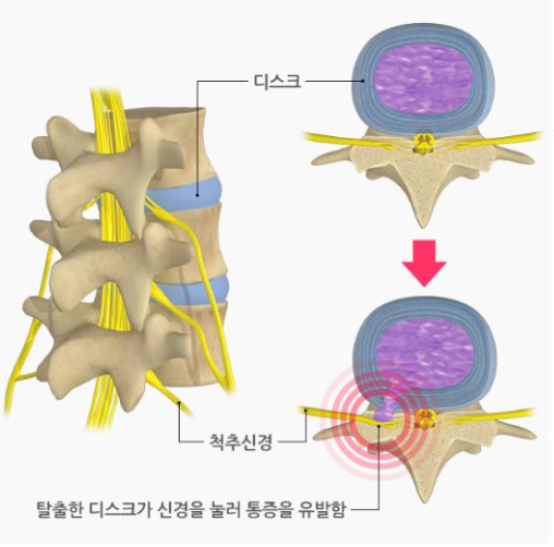 디스크라고 불리는 추간판 탈출증의 단면