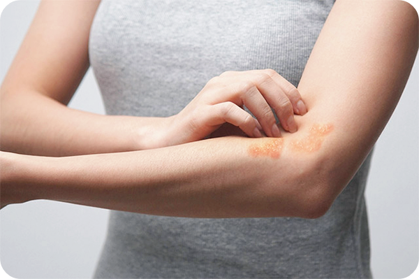 프로폴리스-효능-알레르기