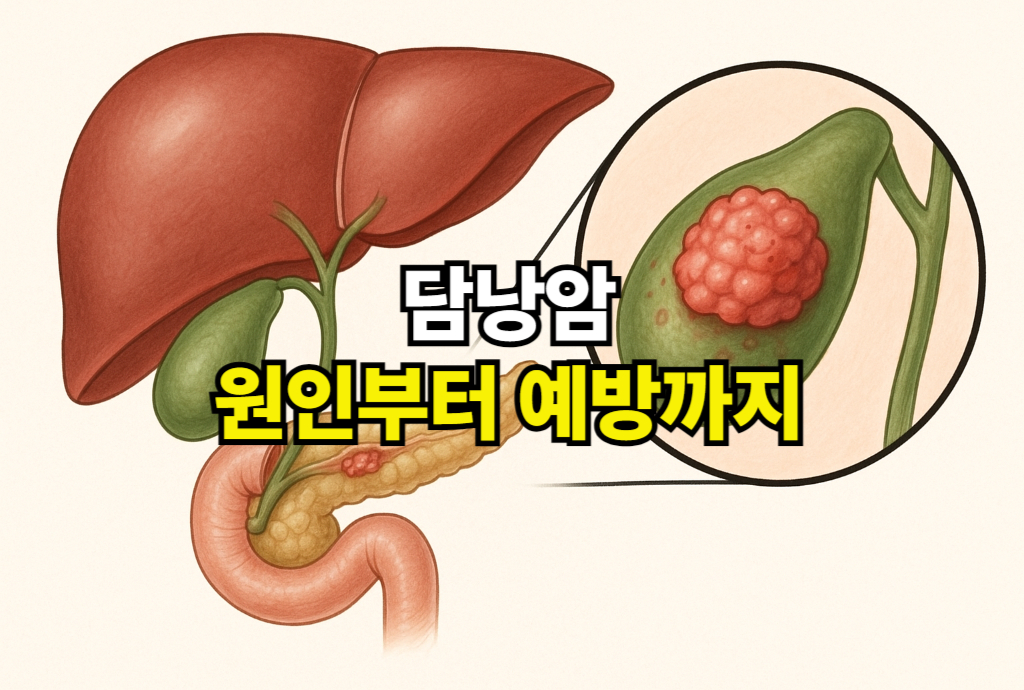 담낭암