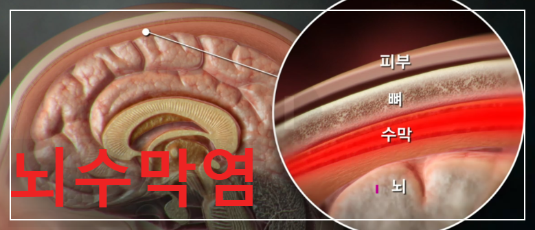 감기증상과 비슷한 뇌수막염