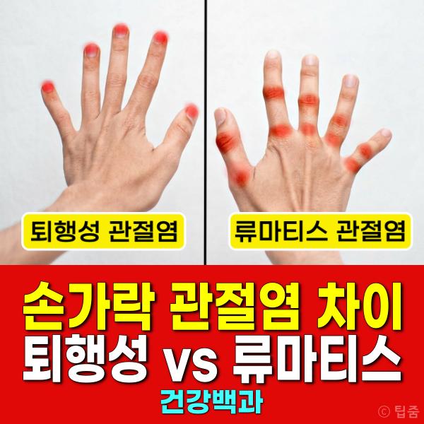 손가락 관절염 퇴행성 류마티스 구분