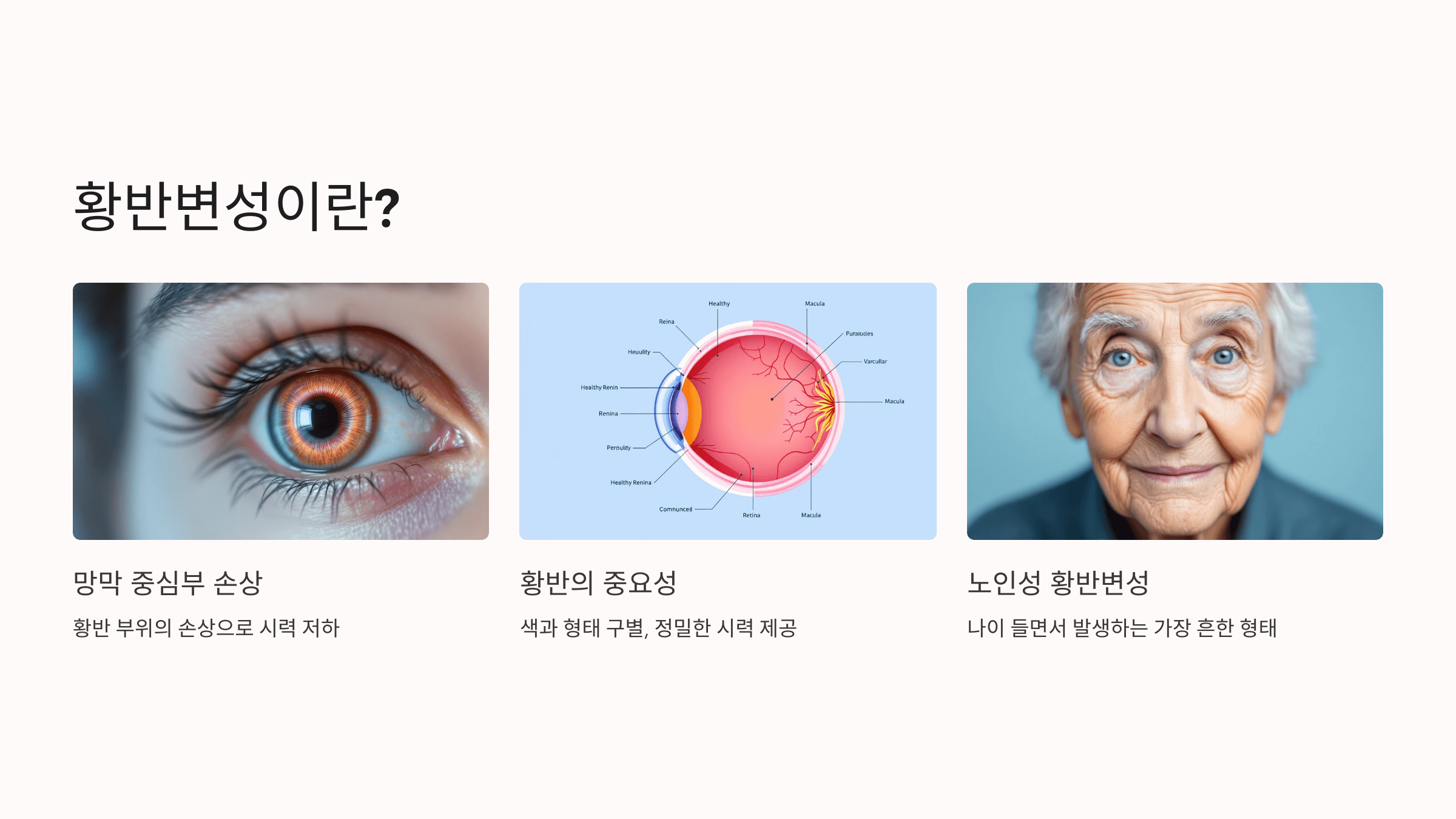 황반변성과 관련된 사진입니다.