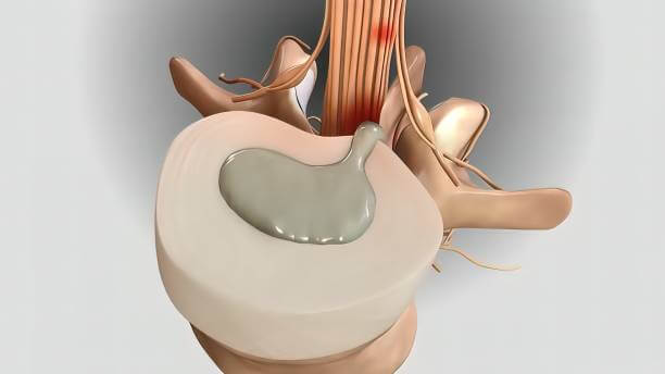 뒷목 땡김 이 있는 두통 여러가지 원인들이 있습니다. 두통이 있을 때 목 뒤가 따끔거리는 느낌이 들고 어깨 승모근이 뭉쳐져있습니다. 근육이완제와 진통제를 자주 복용하고 어깨를 마사지해도 뒷머리가 쪼개지거나 머리 전체가 터질 것 같은 두통이 계속된다면 매우 힘듭니다. 원인이 무엇인지 참고하시기 바랍니다.