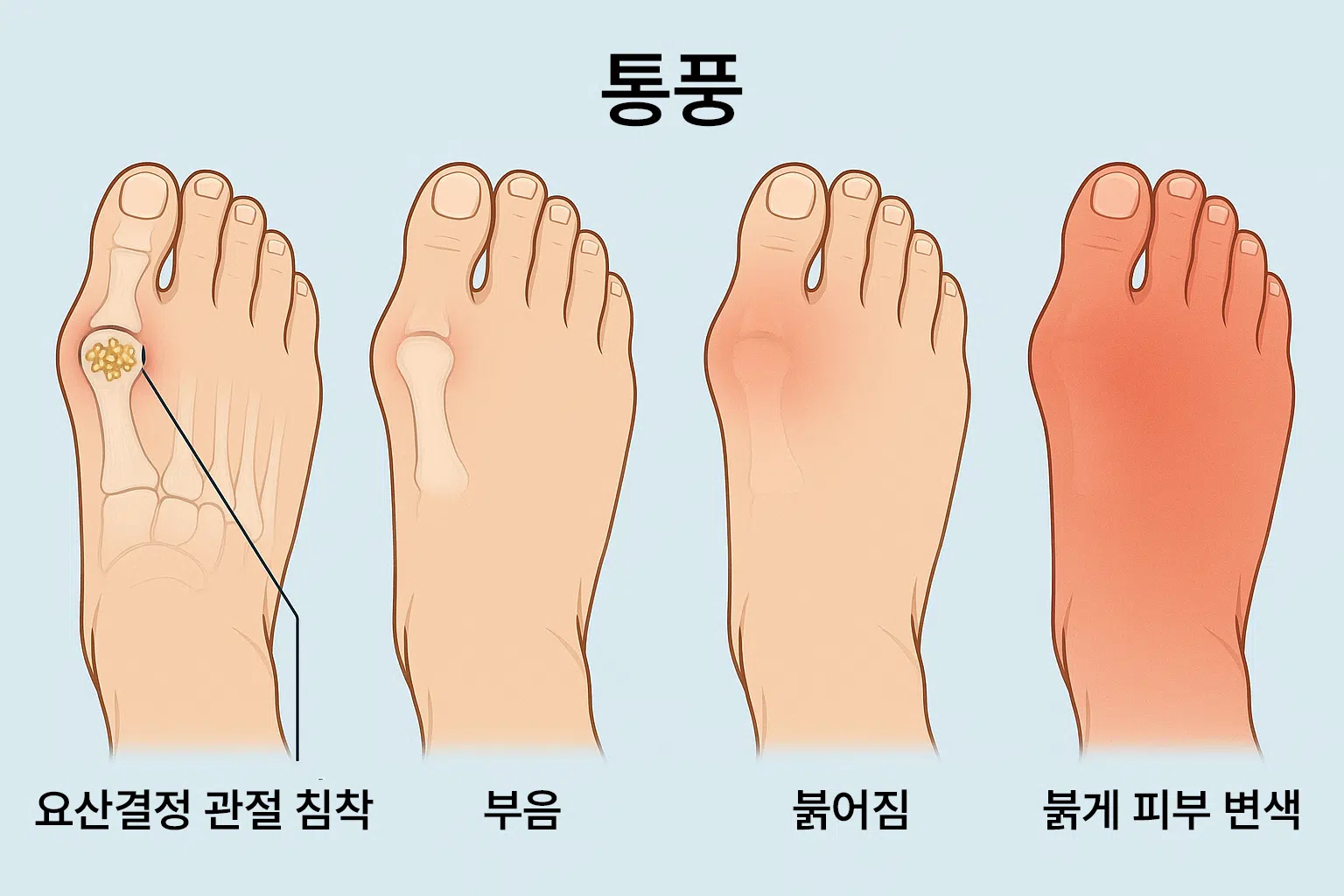 통풍 진행 과정