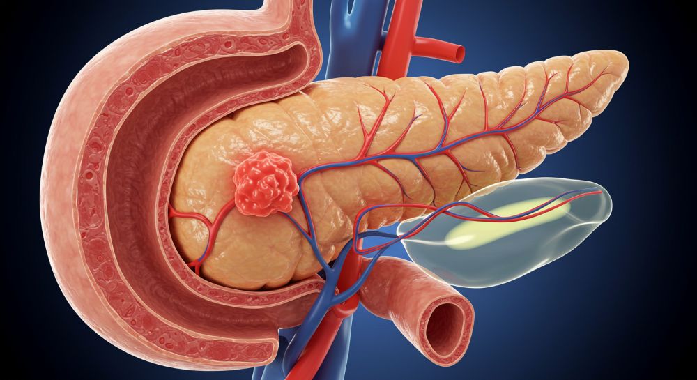 췌장암 초기증상 6가지