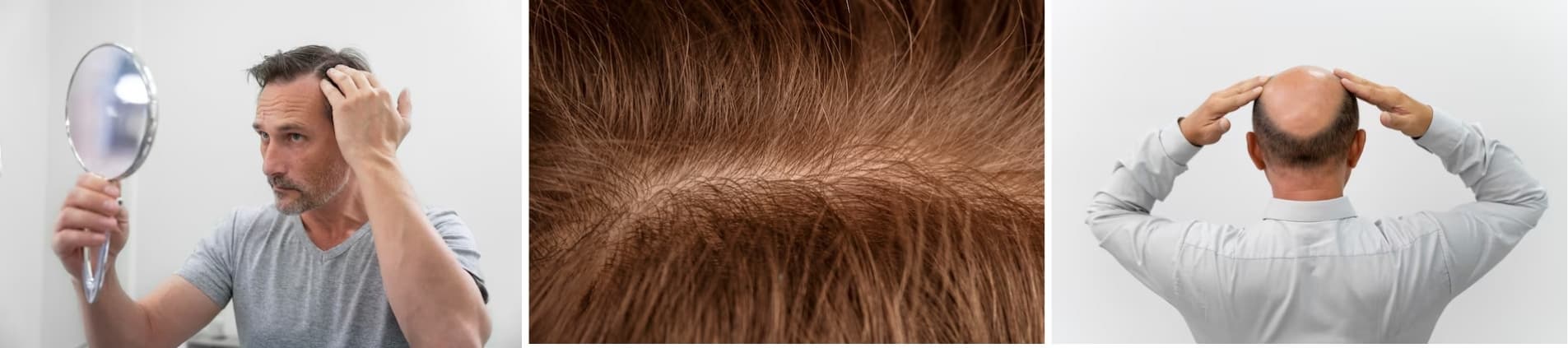 [탈모] 어느 병원 가야 할까? 치료 잘하는 전문 병원 전국 TOP 2