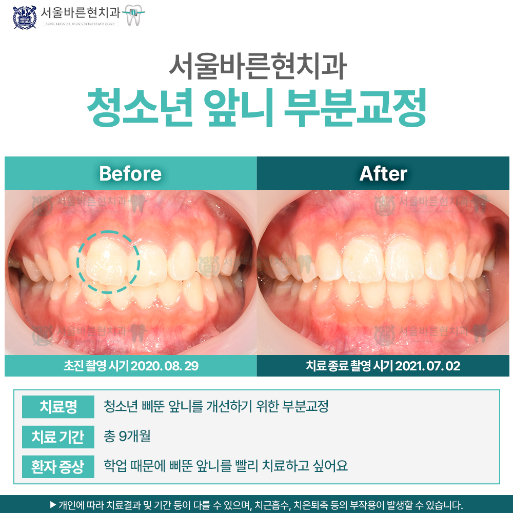 부산치아교정