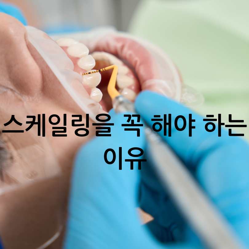 치아 스케일링의 효과와 중요성