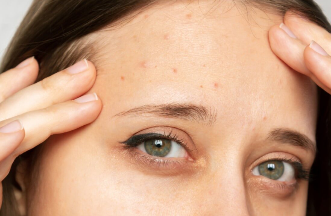 이마에 난 여드름