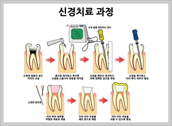 치아신경치료 과정(출처 바른이치과의원)
