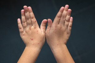 수족구 증상이 손등에 나타남