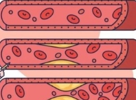 폴리코사놀 대표적 효능 혈관건강 증진1