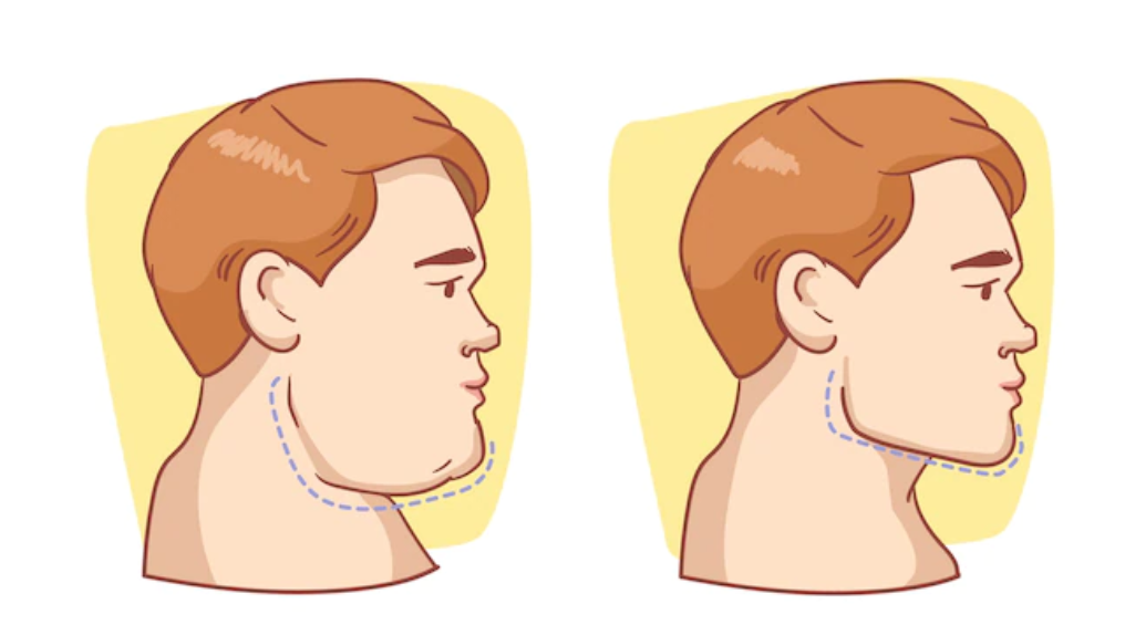 주걱턱을 개선한 남자 캐릭터