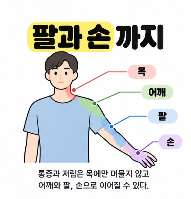 사람의 목, 어깨, 팔, 손에 표시를 붙여 통증과 저림이 이어질 수 있는 부위를 보여 주는 그림