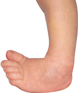 equinovarus