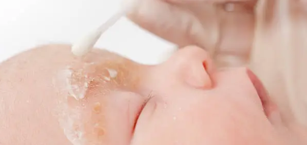 지루성 피부염과 관련된 사진