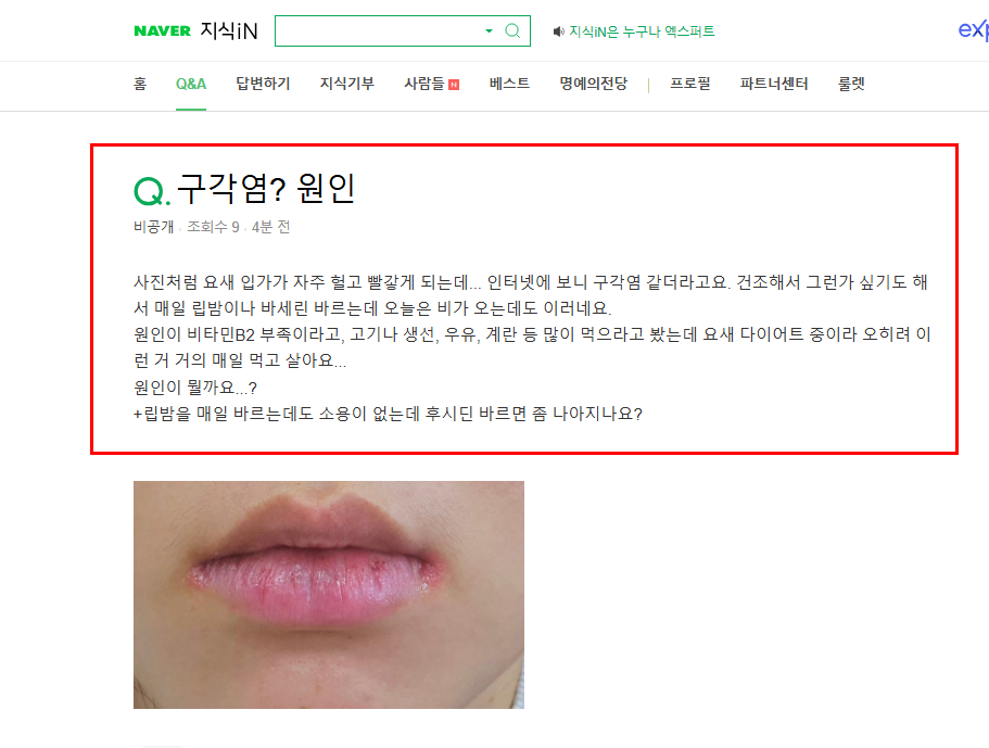 구각염 질문