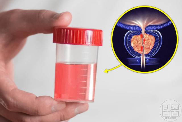 전립선 안좋을때 증상 혈뇨 피가 섞여 나옴