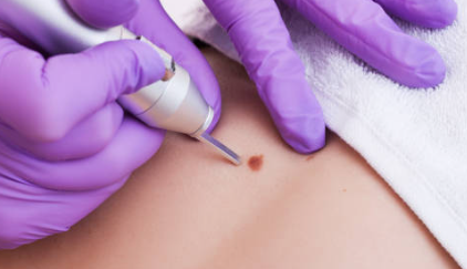 사마귀 제거방법 연고 추천 사마귀 냉동치료 원인 실비보험