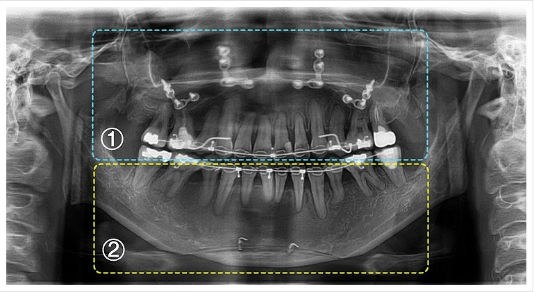 양악수술후(정면)