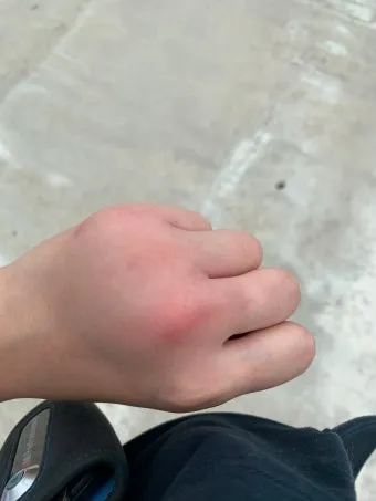 모기 물려 가려울 때 땀띠에 안티푸라민 연고 효능 부작용 사용후기_17