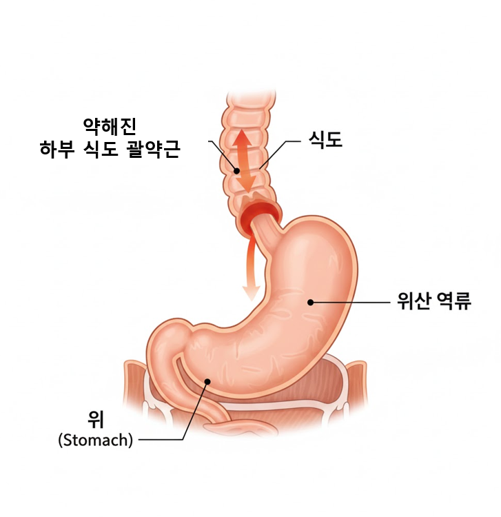 위산이 식도로 역류하는 위식도역류질환 원리 해부도