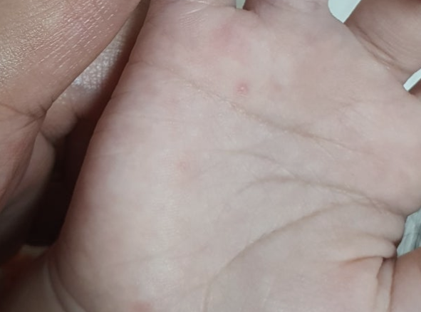 수족구 수포 - 작은 물집 하나에 무너진 엄마의 하루