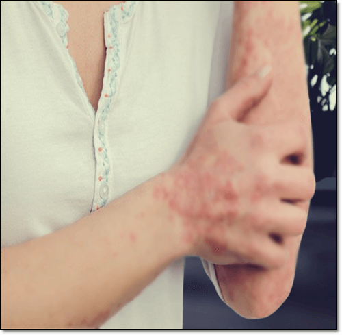 아토피 피부염 환자