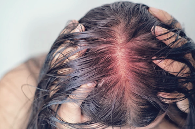 머리 가려움증의 원인