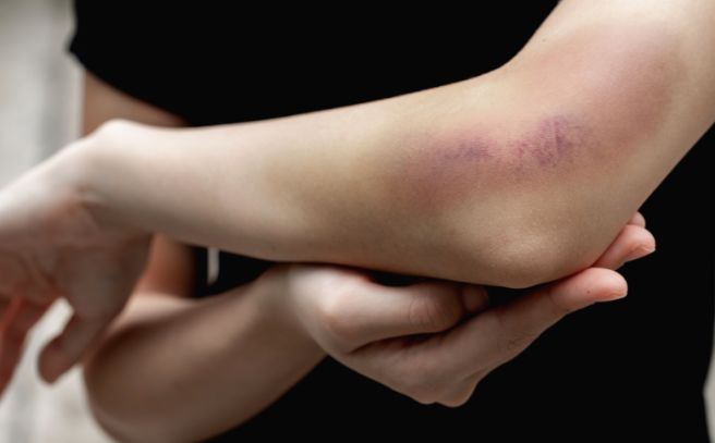 몸에 멍이 잘드는 이유