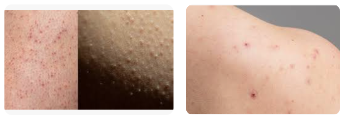 모공 각화증의 원인과 관리 방법