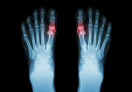 통풍에 좋은 음식 해로운 음식, 증상