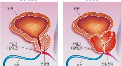 전립선암이미지